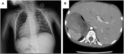 Individualized Surgical Reconstruction of the Right Ventricle Outflow Tract in Double Outlet Right Ventricle With Mirror Image-Dextrocardia